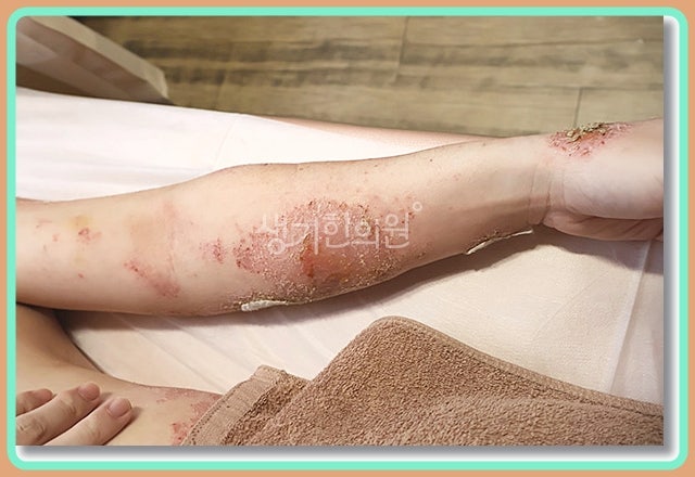 광교화폐상습진 연고 사용 후 괜찮아졌다가 다시 나타났다면?