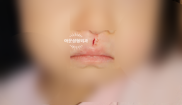 소아 수면마취 봉합에 대해(서울 강동구 아문성형외과)