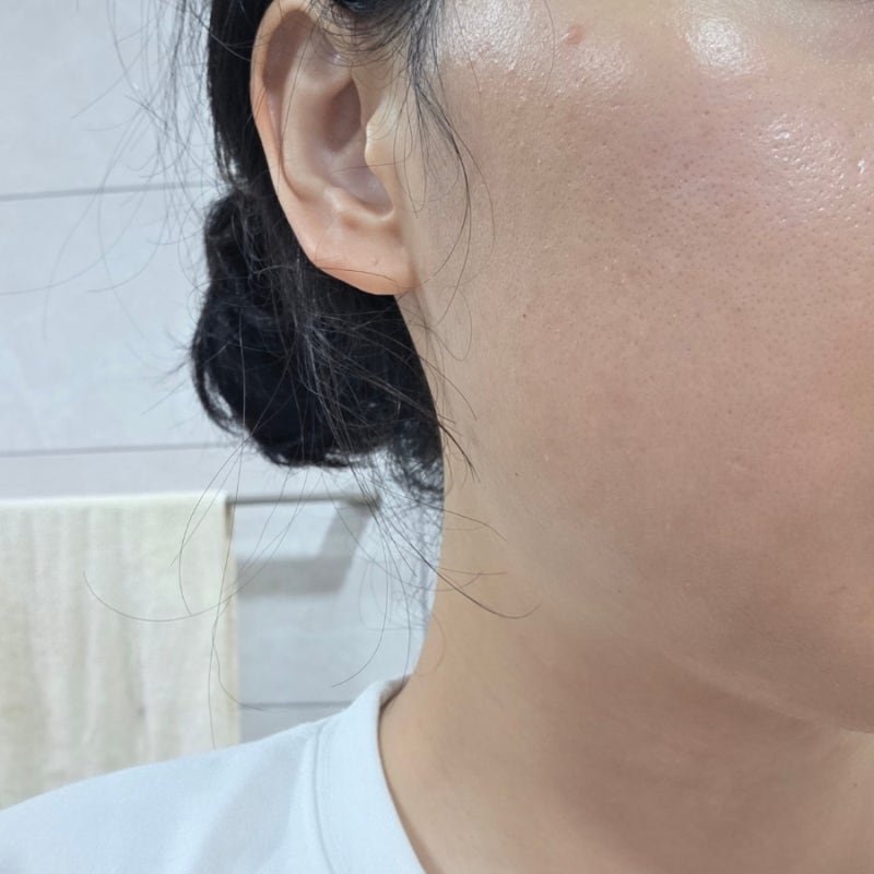 [턱교정수술 후기 1/2] 턱교정수술(양악수술) 전 준비해야할 것 | 치아교정 기간 | 수술 후 한....