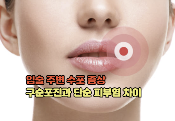 입술 주변 수포 증상 구순포진과 단순 피부염 차이