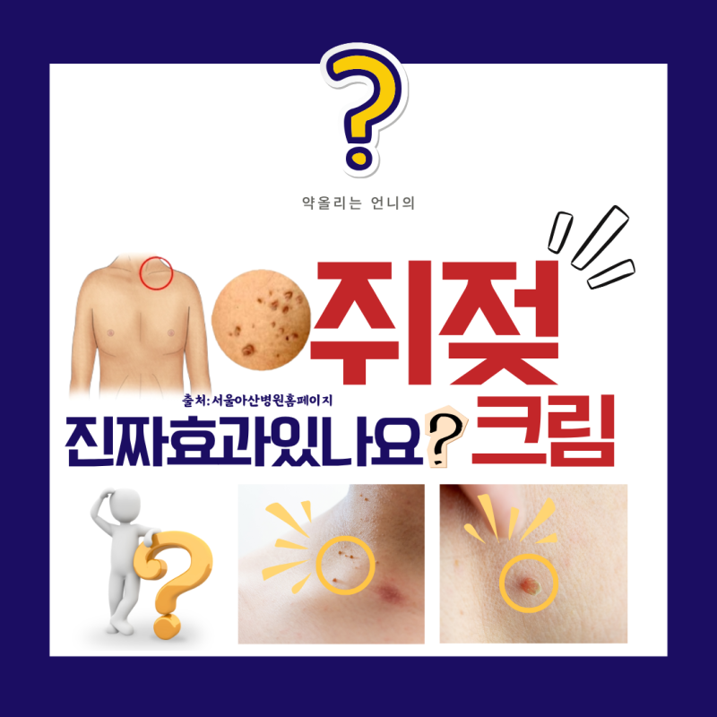 쥐젖 크림, 효과 있을까요?(살리실산/티눈약/비립종제거)
