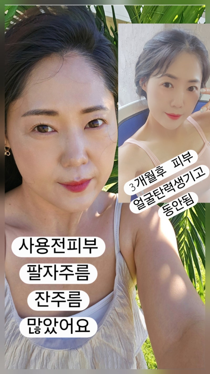 [내돈내산] 장나라 고주파 디바이스 eoa 풀써마 3개월 솔직 사용 후기 (팔자주름·탄력 변화 & ....