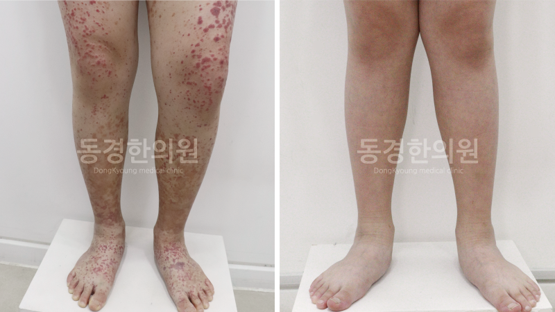 소아 자반증, 전염병일까?