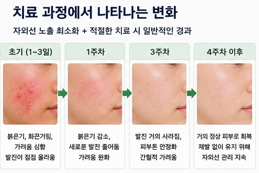 햇빛 알레르기 얼굴 빨개짐, 화끈거림까지 생기는 증상과 이유 치료 후기