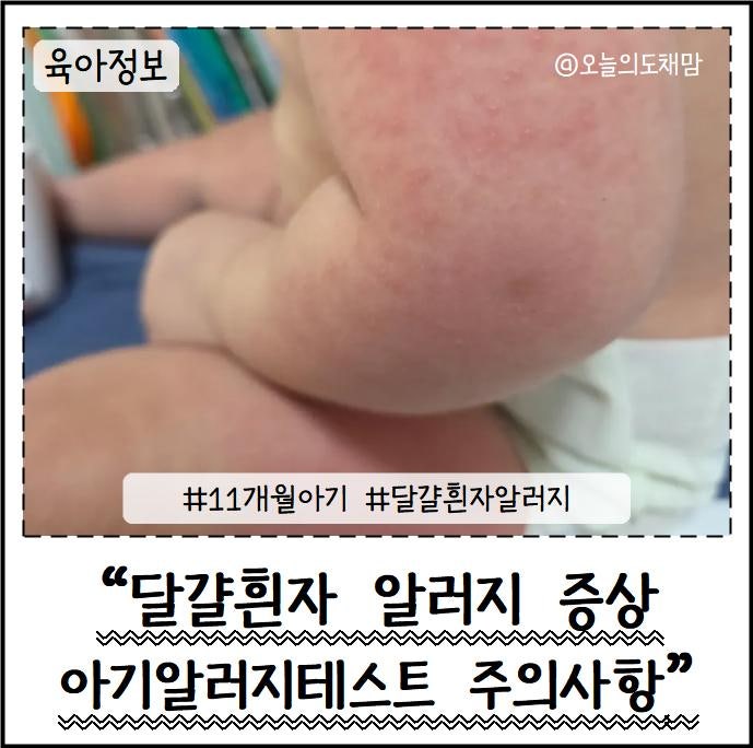 11개월 아기 달걀알러지 증상 피부 발진 치료 주의사항