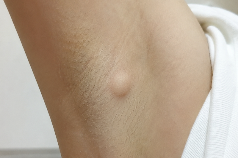 수유 겨드랑이 피지낭종 제거 병원, 당일 제거 전 꼭 알아두세요