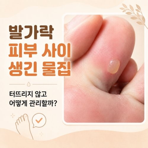 발가락 피부 사이 생긴 물집, 터뜨리지 않고 어떻게 관리할까?