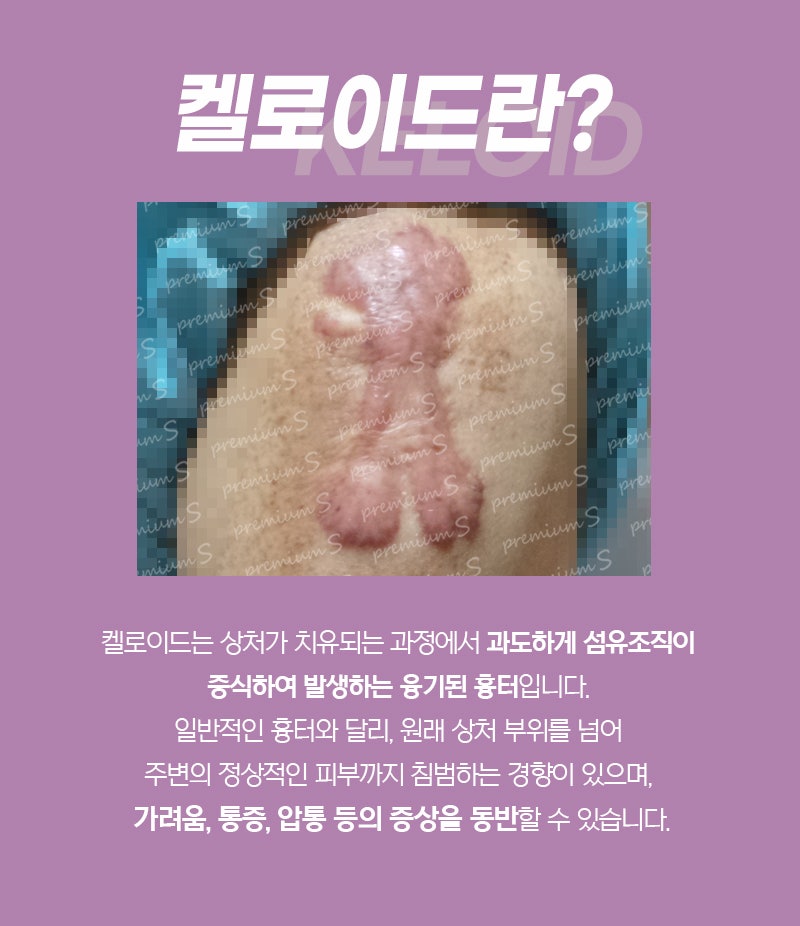 부산켈로이드제거 수술 vs 주사·레이저 추천