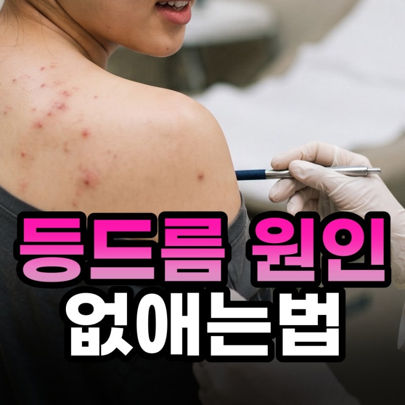 갑자기 생긴 등드름 원인이 뭘까? 없애는 법과 주의사항 알아보면