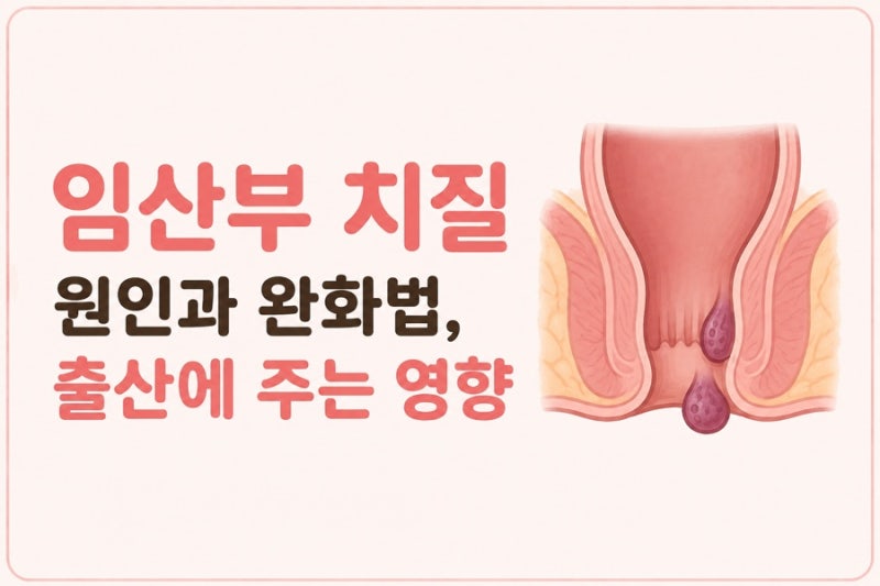 임산부 치질 | 원인과 완화법, 출산에 주는 영향