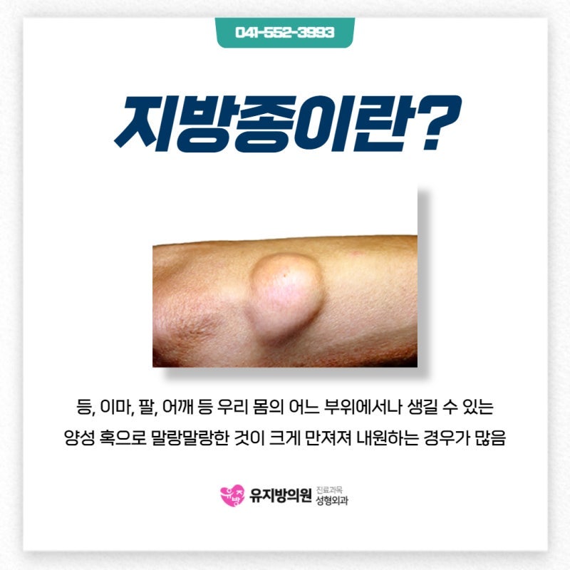 엉덩이에 생긴 지방종(Lipoma) 제거 수술 사례