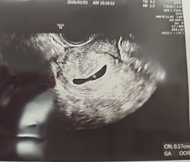 절박유산 이슈ㅠ