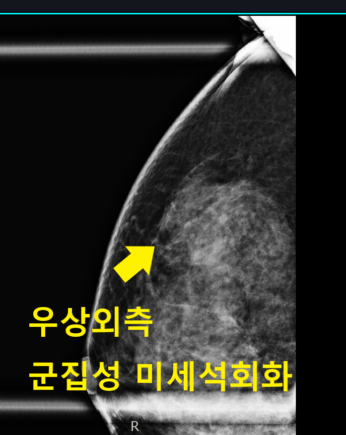 우측 유방 군집성 미세석회화 조직검사, 입체정위유방생검술로 진단한 상피내암 사례
