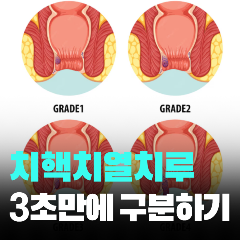 치핵 치열 치루 차이 3가지 통증으로 구분법