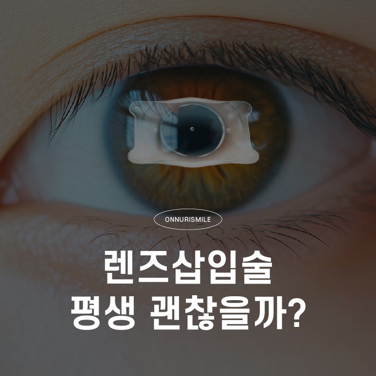 렌즈삽입술, 평생 눈에 넣어도 괜찮을까? 오래 사용할 수 있는 이유와 꼭 알아야 할 점