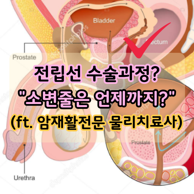 "소변줄은 언제까지?" 전립선 수술과정은? (ft. 암재활전문 물리치료사)