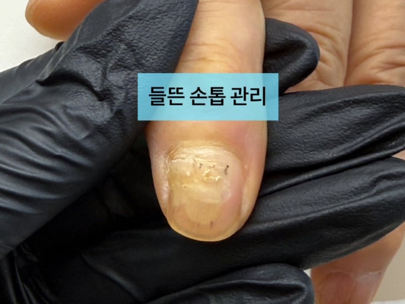문에 손가락 끼임, 들뜬 손톱 그냥 두면 안 되는 이유｜들뜬 손톱 관리와 케어 방법