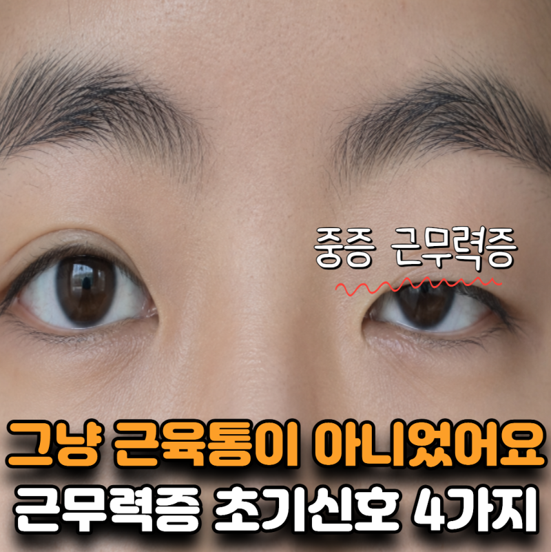 “더위 먹은 게 아니었습니다” 중증근무력증 초기신호 4가지