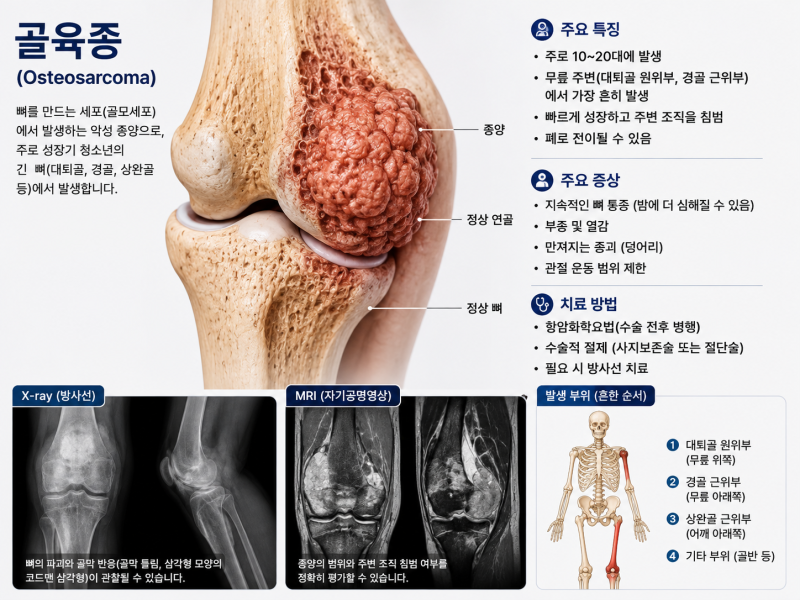 뼈암이란? 골육종·유잉육종·연골육종 초기증상과 치료 알아보기