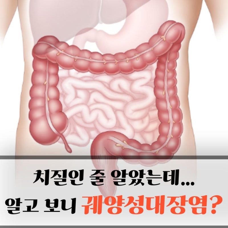 과민성대장증후군 VS 궤양성 대장염..복통 반복되는 30대가 놓치기 쉬운 '이 차이'