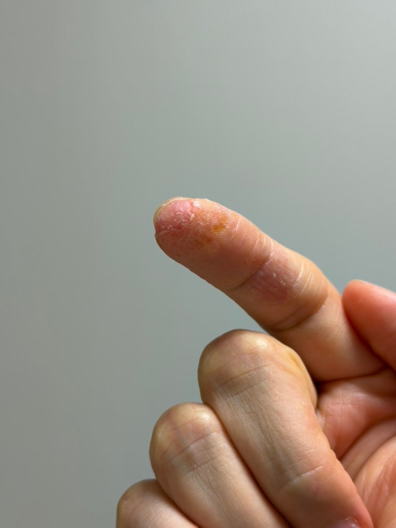 한포진 연고 세가지 사용 후기(락티케어, 비판텐, 헤르페진)