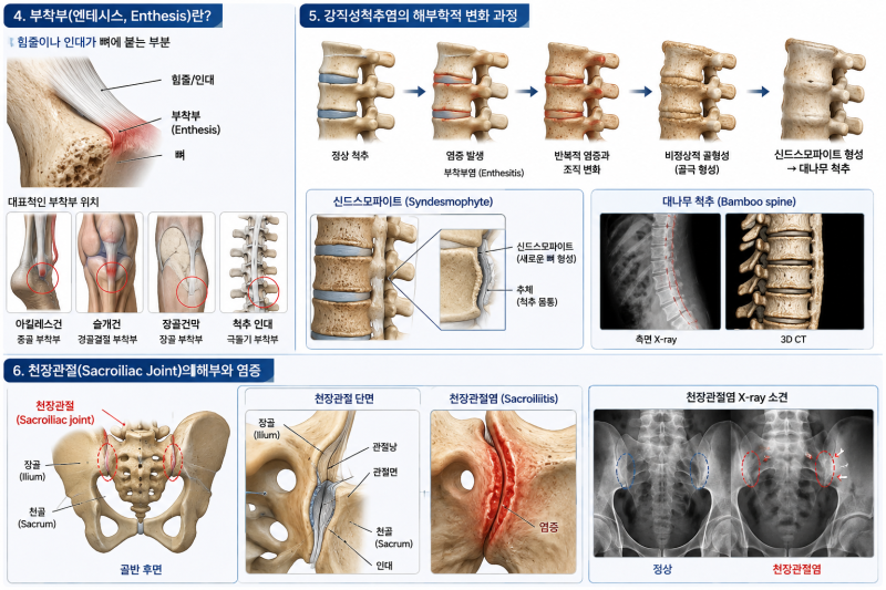 아침마다 허리가 뻣뻣하다면? 강직성척추염 증상부터 원인, 허리디스크와 차이까지