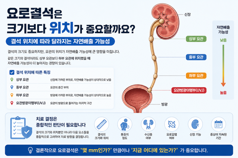 요로결석은 크기보다 위치가 중요할까요?｜결석 위치에 따라 달라지는 자연배출 가능성