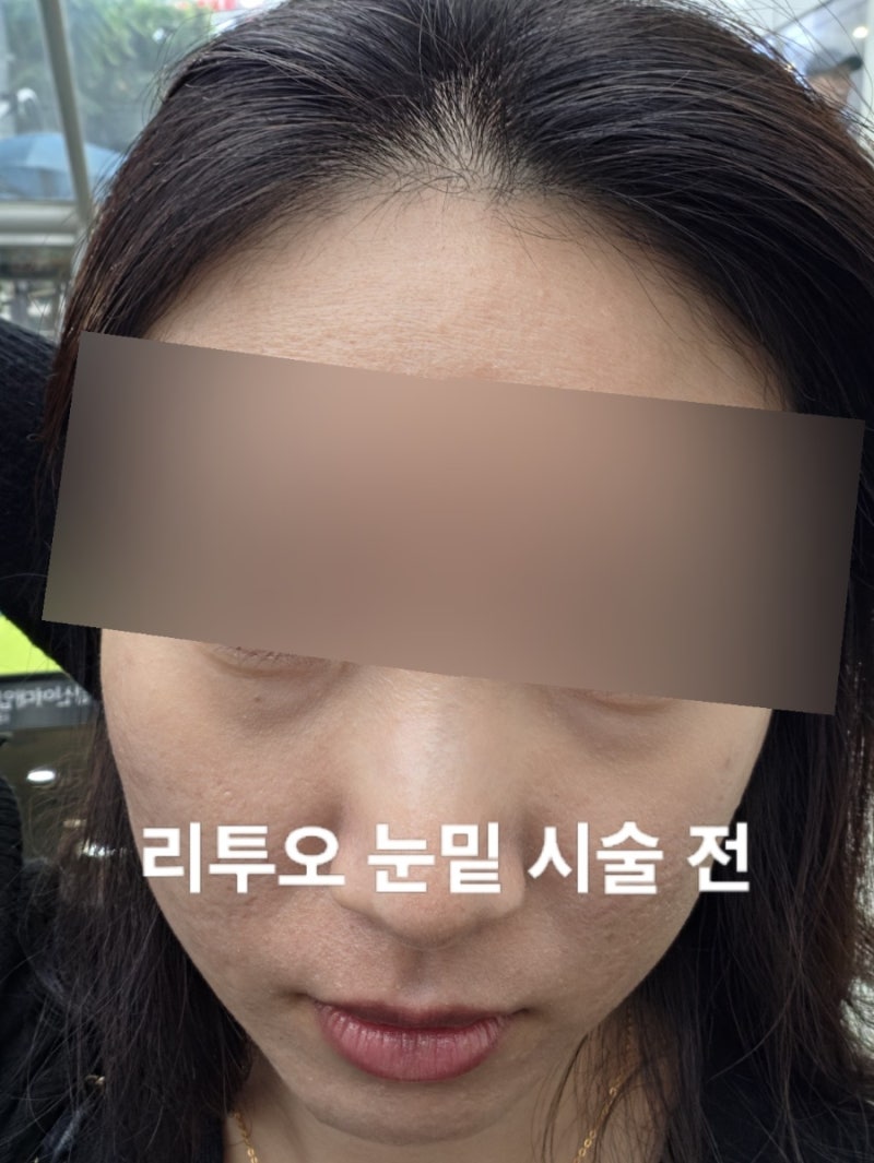 눈밑지 대신 리투오 2주 효과 찐 후기(통증, 멍 붓기, 다크서클 전후비교)