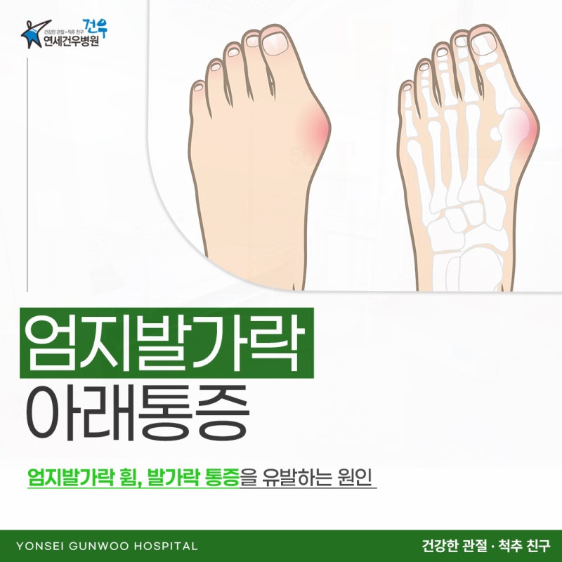 엄지발가락 아래 통증 무지외반증인데 왜 옆보다 발바닥이 아플까요?
