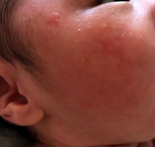 아기 모공각화증 유아 닭살피부 아기 보습크림 믿을만한 성분으로 관리했어요