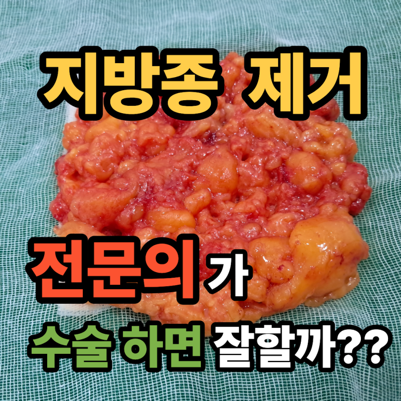 지방종 전문의가 제거 수술 하면 잘할까?