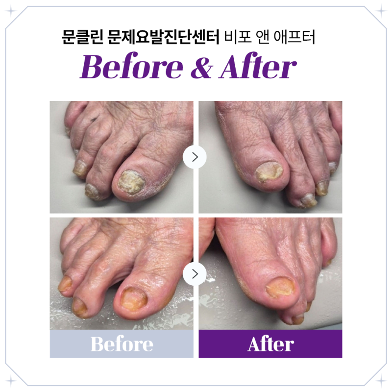 김포내성발톱병원, 발톱이 살을 파고든다면 방치하지 마세요