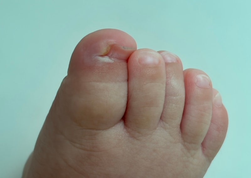 7개월 아기 내성발톱, 피부 염증으로 인한 매듭병원 소아정형외과 진료 후기