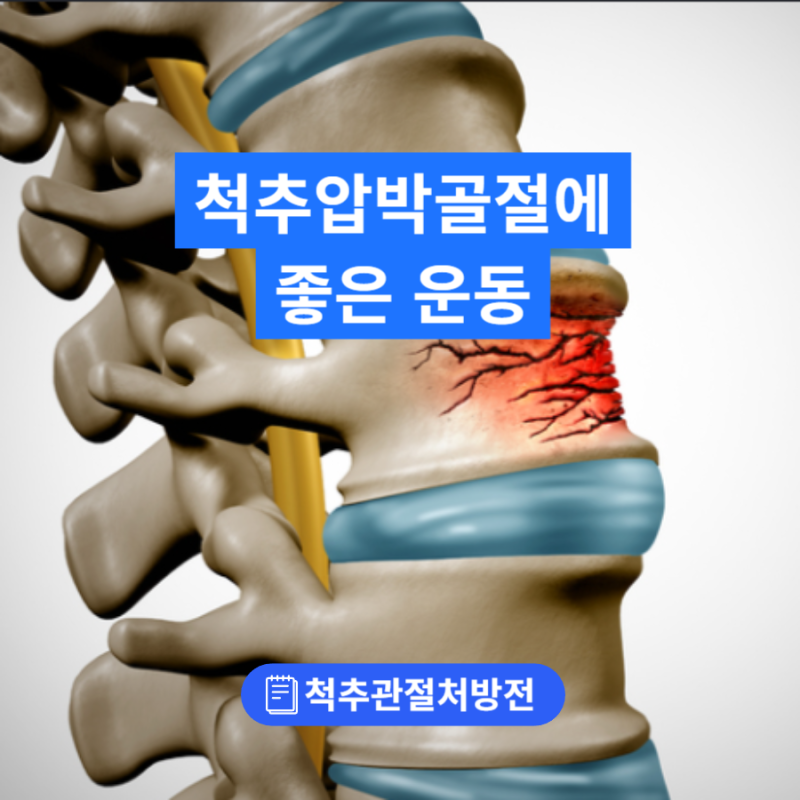 척추압박골절 비수술 치료 중, 어떤 운동이 도움이 될까요?
