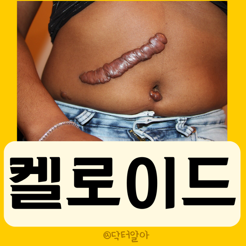 의사가 설명하는 켈로이드흉터 정의 증상 원인 진단 치료 예방