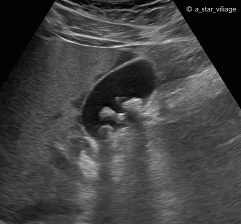 담낭결석(Gallstone)은 왜 생길까? 깨거나 녹일 수 있을까?