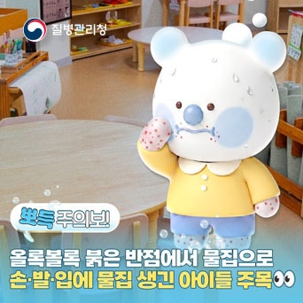 수족구병 유행 중! 우리 아이 열나고, 입안에 물집이 생겼다면?