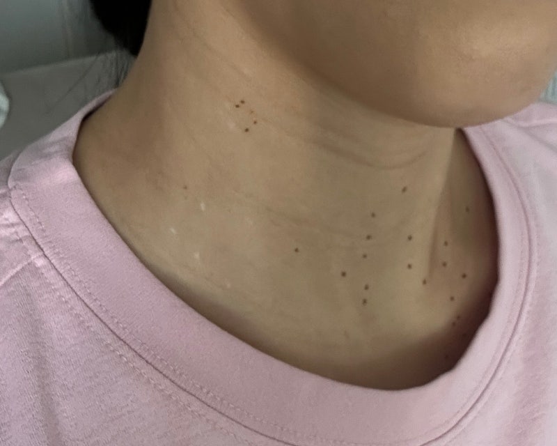 편평사마귀 레이저 제거 후 관리방법 +흉터관리,재생크림
