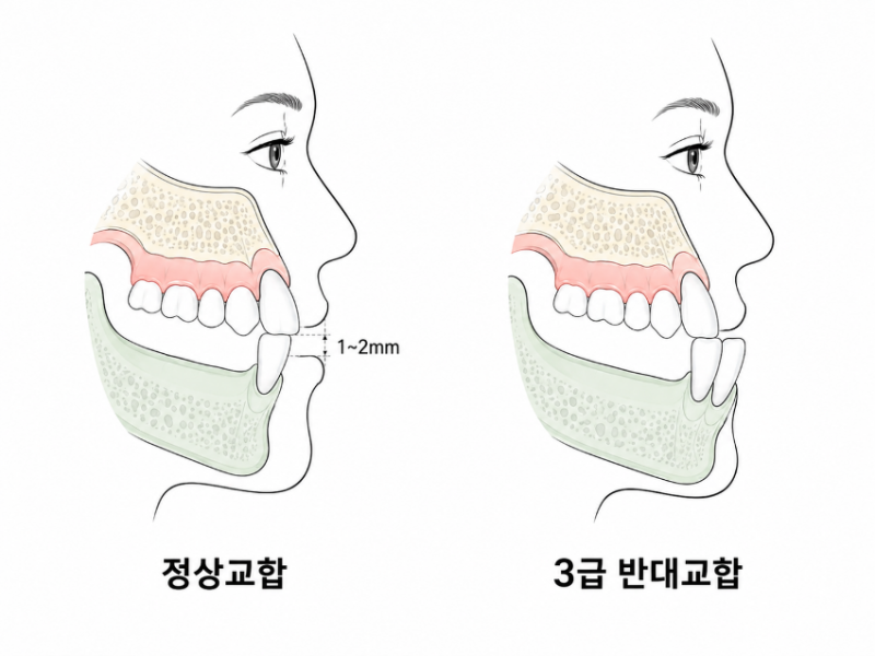 [치과교정과 전문의가 알려주는] 내 치아는 몇 급일까? 부정교합 종류와 특징 총정리