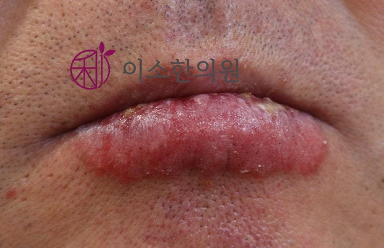 입술 진물 각질, 구순염 만성화 막는 핵심 관리법 주의사항 3가지