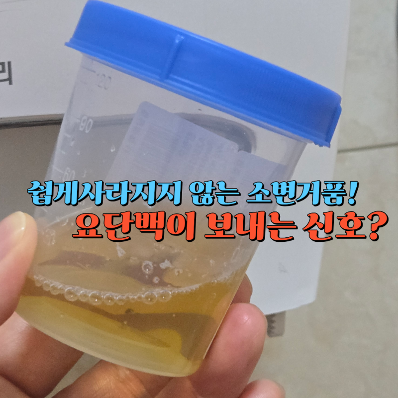 소변 거품은 모두 단백뇨일까? 요단백 원인과 검사 방법