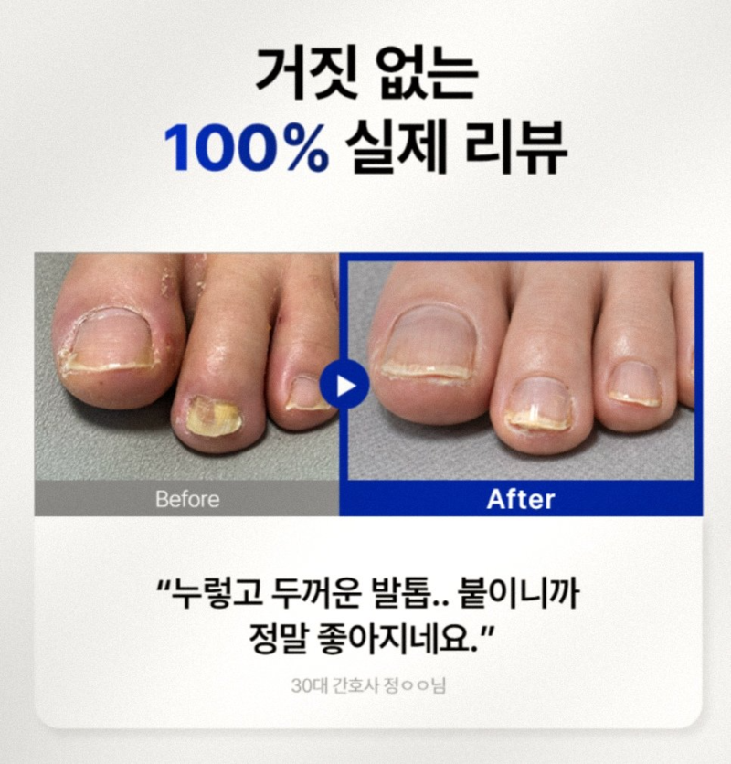 붙이는 손발톱 영양제 케라틴 패치 인버브로 상한 발톱 나이트케어 해본 후기