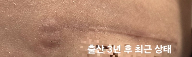 제왕절개 켈로이드 주사 많이 아플까? 20회 정도 맞은 실제 통증과 변화