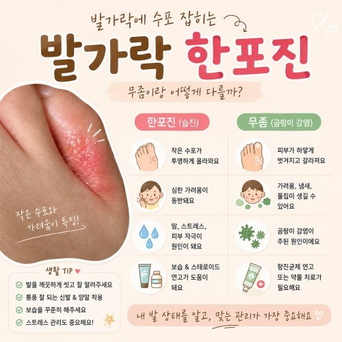 발가락에 수포 잡히는 한포진, 무좀이랑 어떻게 다를까?