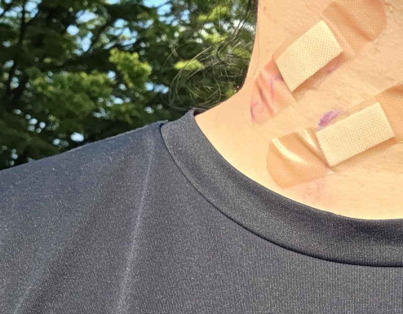 38세 여성 갑상선암 진단 후기｜반절제 후 림프절 전이 발견, 결국 전절제까지