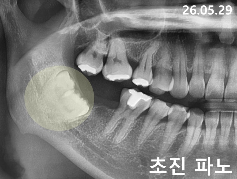 매복 사랑니 발치 통증 언제까지? 드라이 소켓으로 통증 해결 방법 총정리