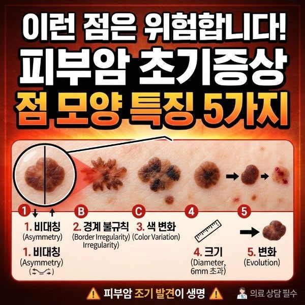 "이런 점은 위험합니다" 피부암 초기증상 점 모양 특징 5가지