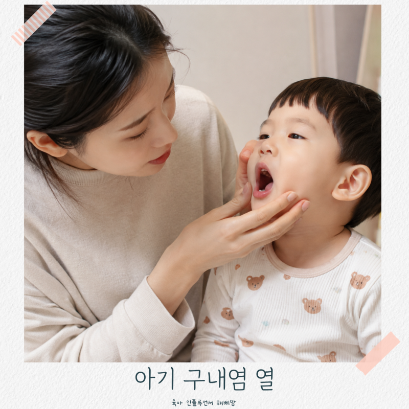 아기 구내염 열 입안 잇몸 입술 혓바닥까지 번지면