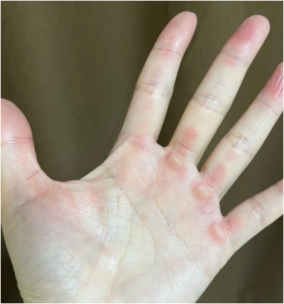 손굳은살제거 집에서 진짜 되는 방법 있을까