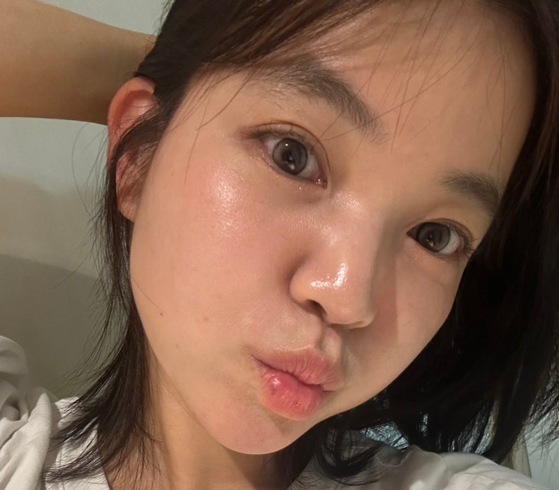4년 여드름 치료 후 결국 복용한 이소티논 후기｜처방부터 가격, 복용법, 부작용까지